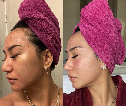 BodyLove™ - Kojic Acid & Turmeric Soap